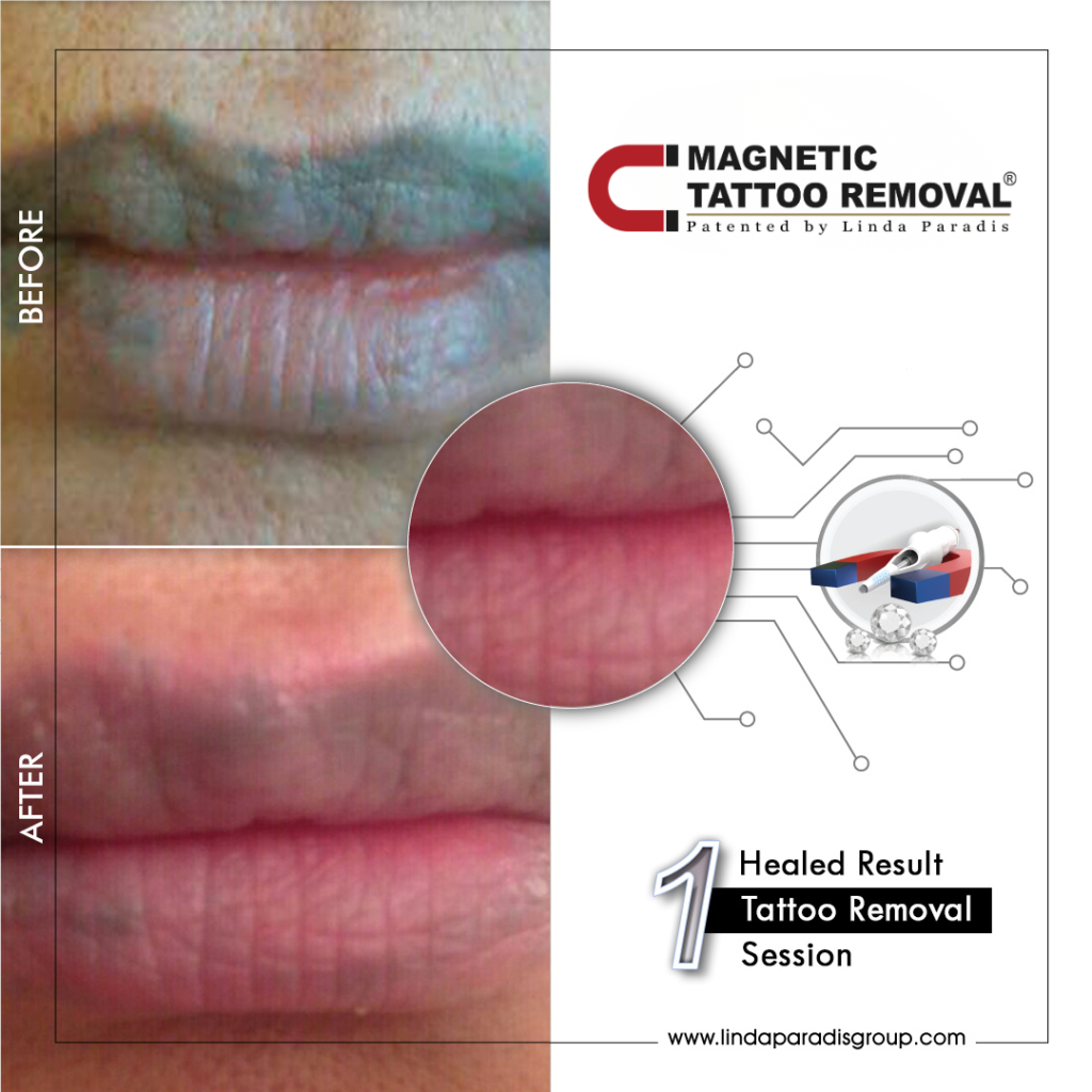Before and after: lip liner lifted with the Magnetic Tattoo Removal® method, healed result after 1 session