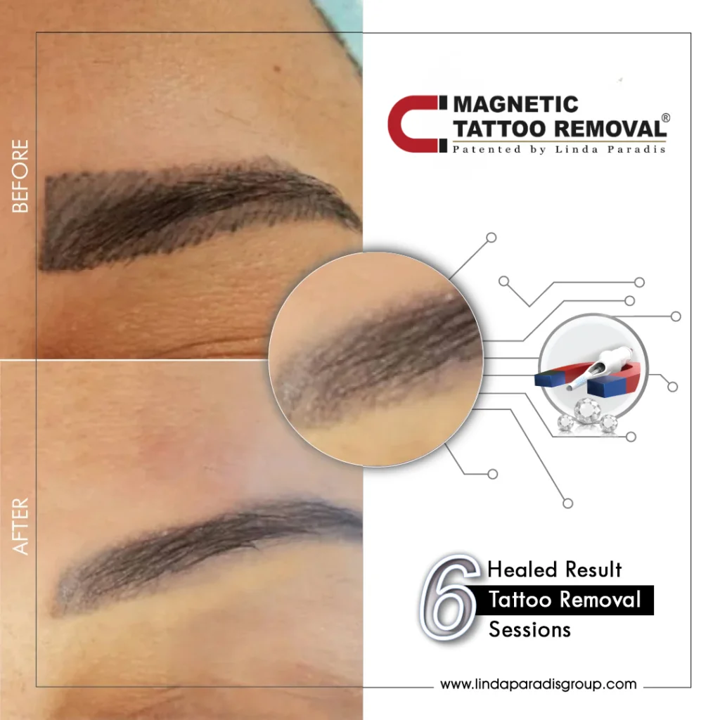 Before and after dark eyebrow tattoo lifted with the Magnetic Tattoo Removal® method, healed result after 6 sessions