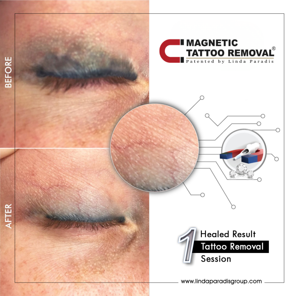 Before and after eyeliner tattoo lifted with the Magnetic Tattoo Removal® method, healed result after 1 session