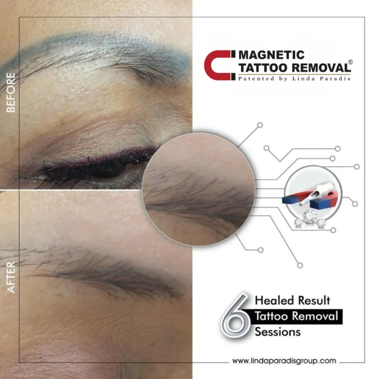 Before and after: grey eyebrow tattoo lifted with the Magnetic Tattoo Removal® method, healed result after 6 sessions
