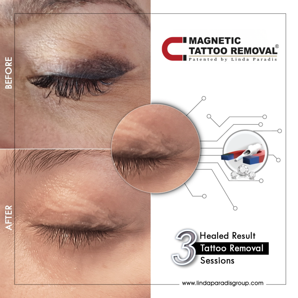 Before and after lash line tattoo lifted with the Magnetic Tattoo Removal® method, healed result after 3 sessions
