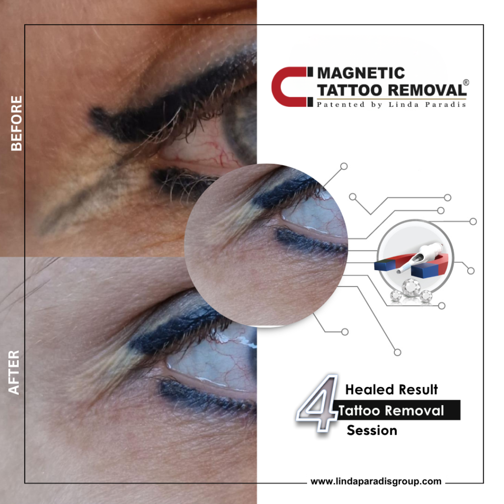 Before and after lash line tattoo lifted with the Magnetic Tattoo Removal® method, healed result after 3 sessions