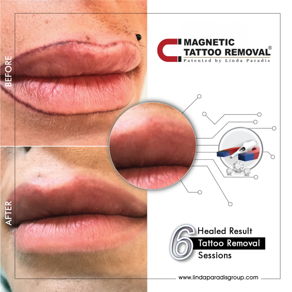 Before and after lip blush lifted with the Magnetic Tattoo Removal® method, healed result after 1 session
