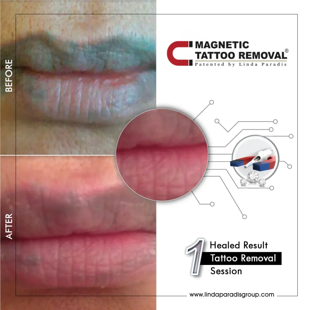 Before and after lip liner lifted with the Magnetic Tattoo Removal® method, healed result after 1 session