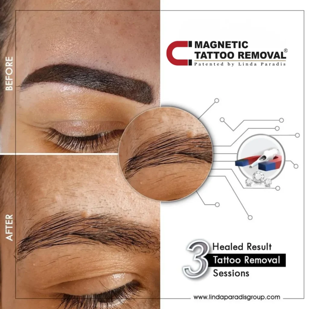 Before and after microblading lifted with the Magnetic Tattoo Removal® method, healed result after 3 sessions