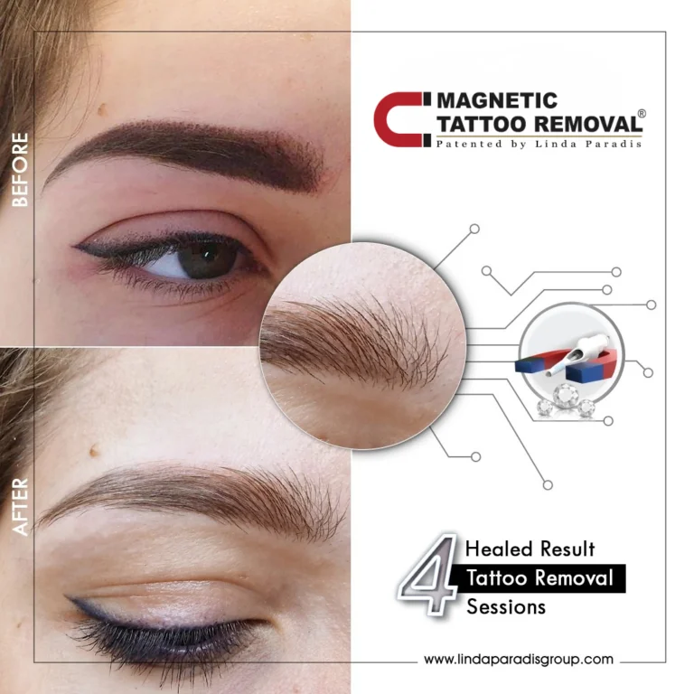 Before and after: powder brows lifted with the Magnetic Tattoo Removal® method, healed result after 4 sessions