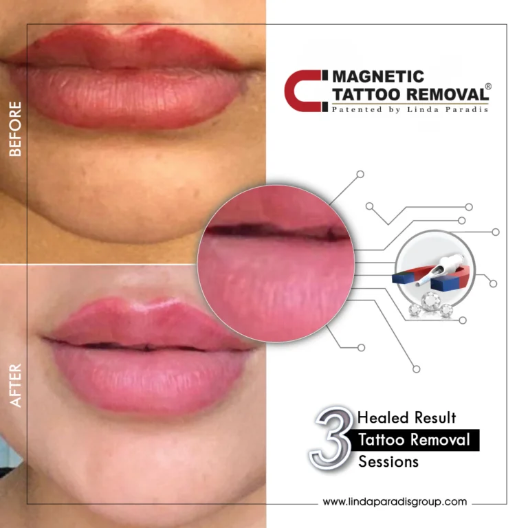 Before and after: lip border tattoo lifted with the Magnetic Tattoo Removal® method, healed result after 3 sessions